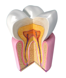 Découpe d'une dent souffrant de parodontite